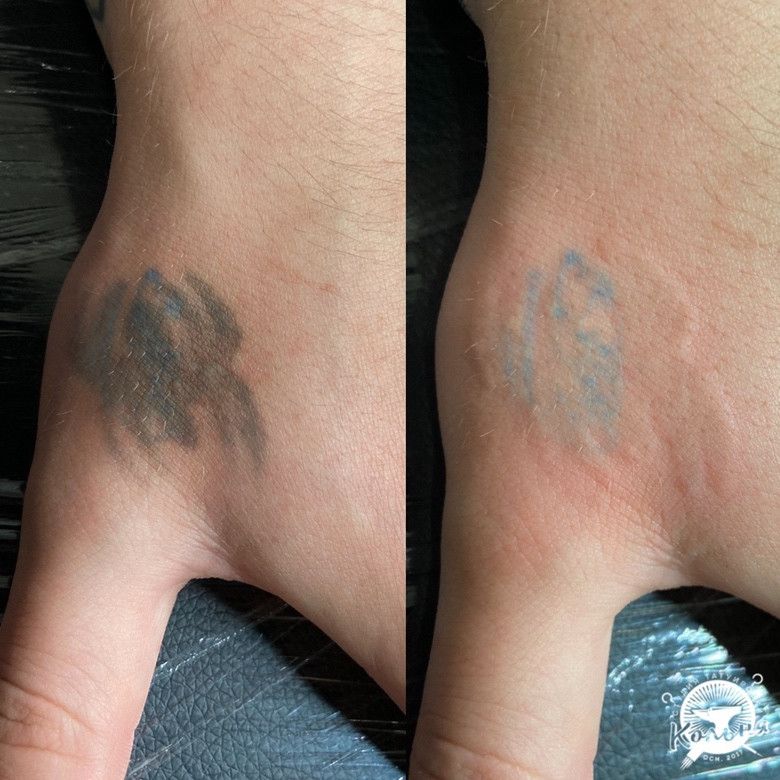 пример лазерного удаления некачественной тату