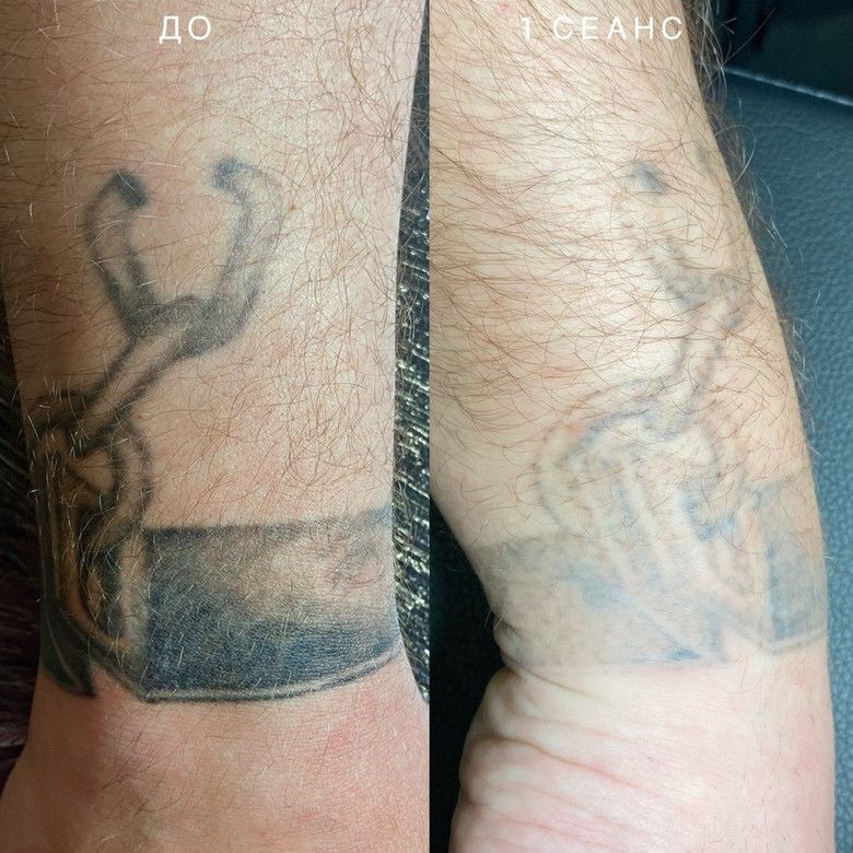 пример лазерного удаления некачественной тату